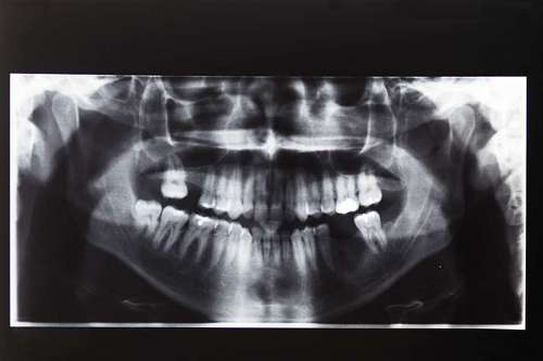 wisdom Closeup x-ray image of teeth and mouth