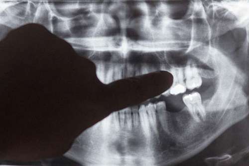wisdom Hand pointing x-ray image of teeth and mouth