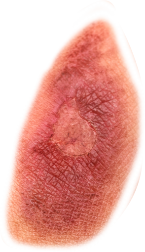 zombie  medicine overlay png wound halloween healthcare and medicine zombie