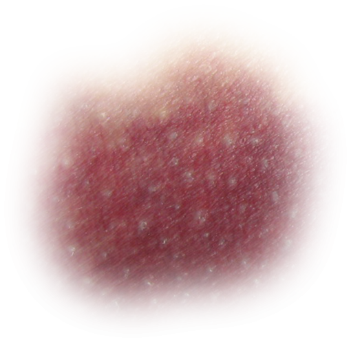 s-more  overlay medicine bruise png backgrounds pain close-up