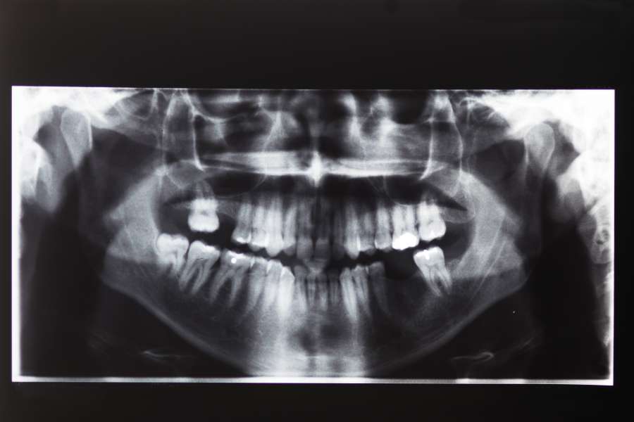 abnormal, abnormality, anatomy, bone, canine, clinic, dental, dentist, dentistry, diagnosis, disease, examination, film, head, health, healthcare, human, image, impacted, incisor, injury, jaw, medical, medicine, molar, mouth, operation, oral, pain, panorama, premolar, radiography, radiology, ray, sick, skeleton, surgery, teeth, tooth, toothache, transparent, white, wisdom, xray, 