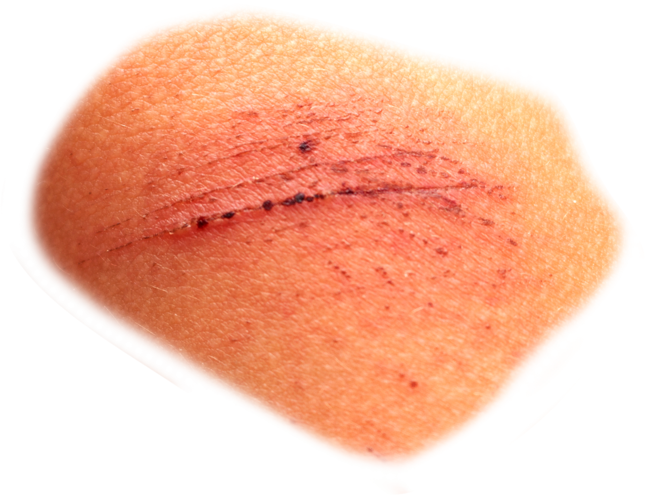  scar,halloween,overlay,png,medicine,pain,healthcare and medicine,physical injury,close-up,surgery,patient,human leg,wound
