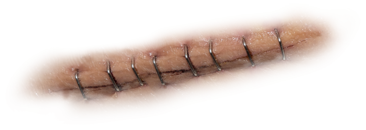  scar,overlay,png,healthcare and medicine,close-up,pain,medicine,surgery,physical injury,patient,human skin,wound